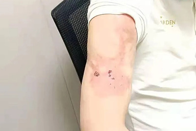 90后小伙儿时烫伤 接受救助见到希望